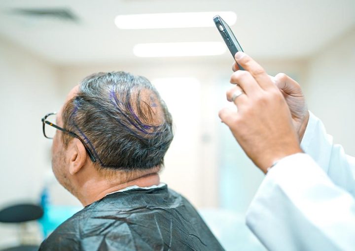 Bald Spot on Crown: Causes, Early Signs & Best Treatments 12 hair transplant crown area