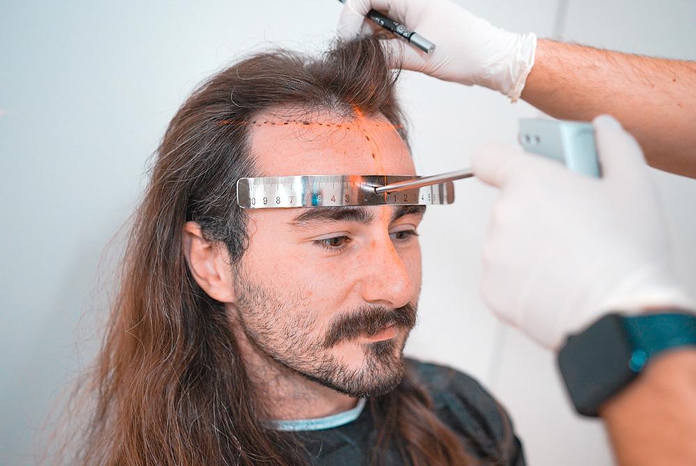 Long Hair Fue 1 long hair fue in turkey