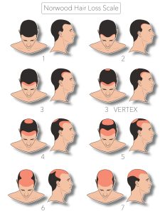 norwood hair loss scale