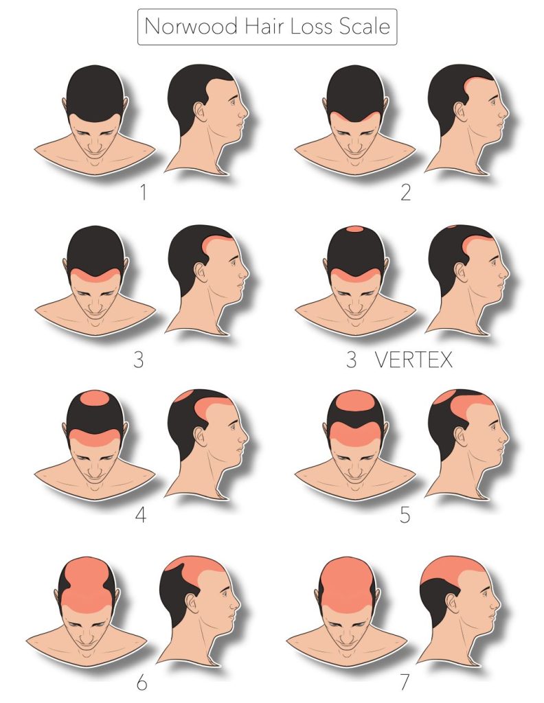 Norwood Hamilton Scale Hair Loss Treatment Guide norwood-hamilton-scale-hair-loss-treatment-guide