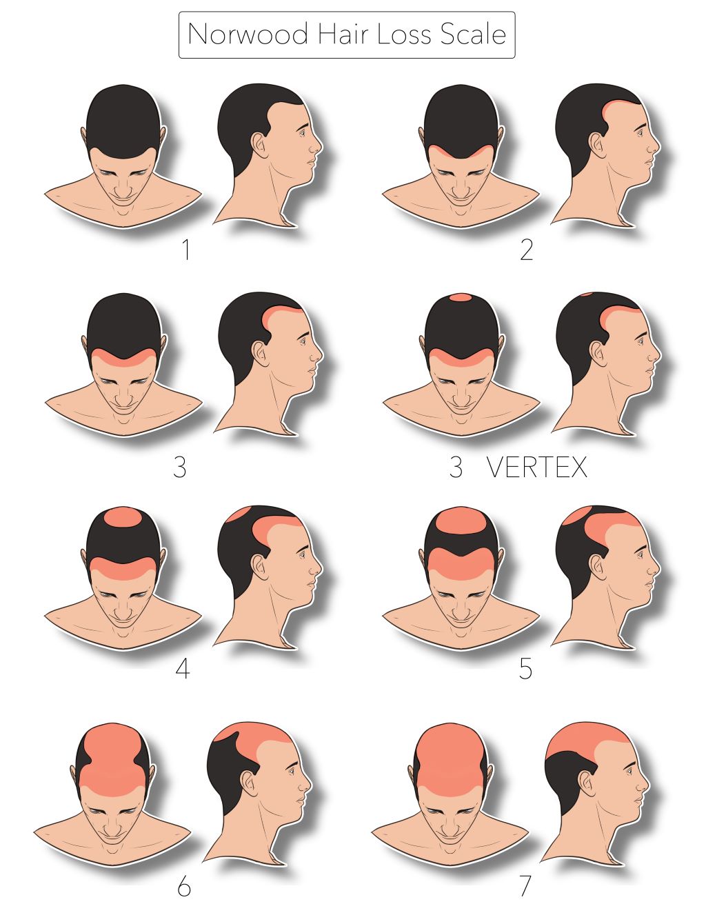 Types of Hairlines: Shapes, Stages & What They Mean (Male Guide) 9 norwood hair loss scale