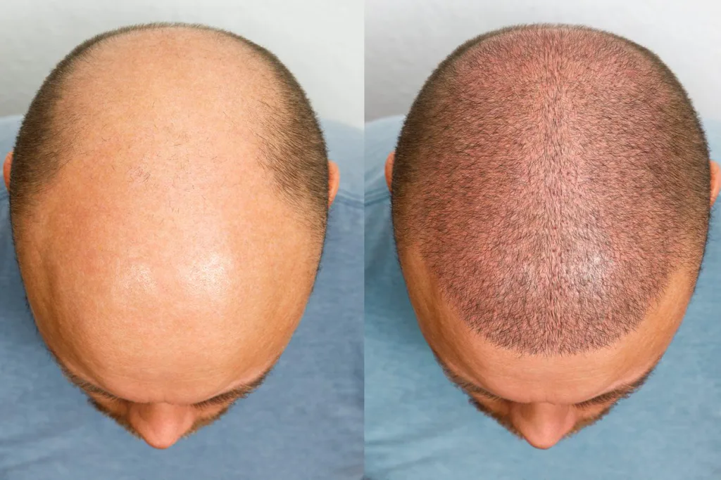 norwood hair transplant