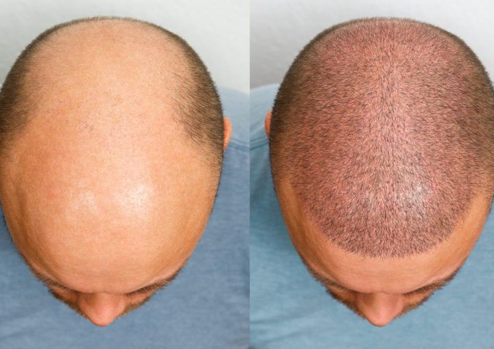 Understanding the Norwood Scale and Its Role 3 norwood hair transplant