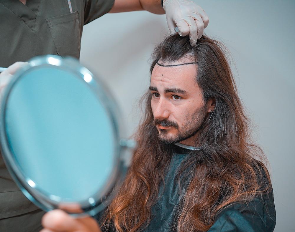Unshaven Hair Transplant 1 unshaven hair transplant in turkey