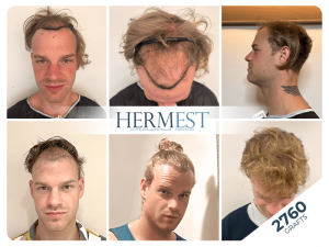 Haare schneiden nach Haartransplantation – Ab wann möglich? 2 Vor und nach der Haartransplantation in der Türkei mit 2760 Grafts