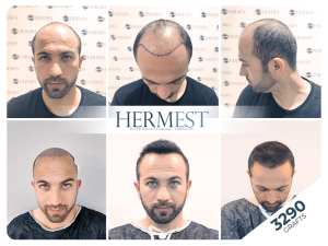 Haartransplantation bei Halbglatze – geht das? 2 Vor und nach der Haartransplantation in der Türkei mit 3290 Grafts