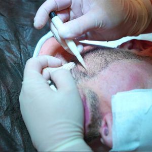 DHI vs FUE – die beste Technik für Haartransplantationen 2 Beispiel einer DHI Haartransplantation