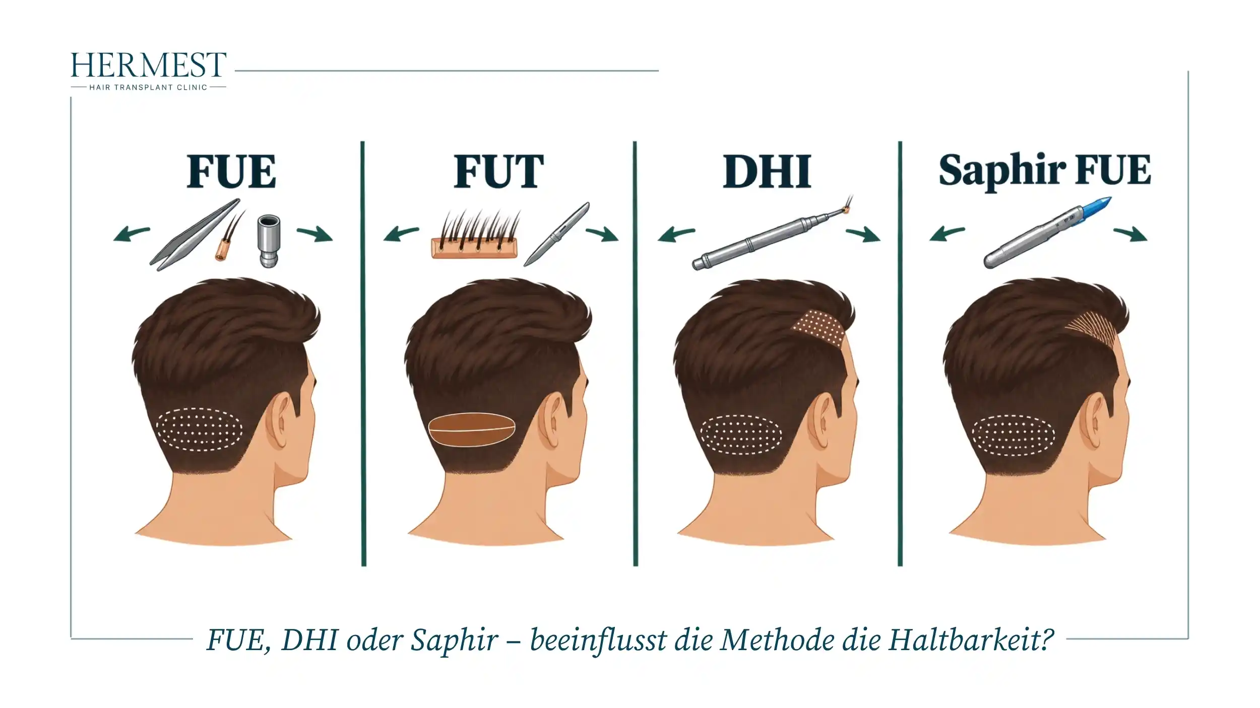 FUE, DHI oder Saphir – beeinflusst die Methode die Haltbarkeit