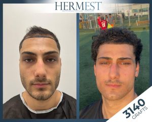 Geheimratsecken mit 20 – Ursachen, Anzeichen und Behandlung 2 Haartransplantation Vor- und Nachher Bild