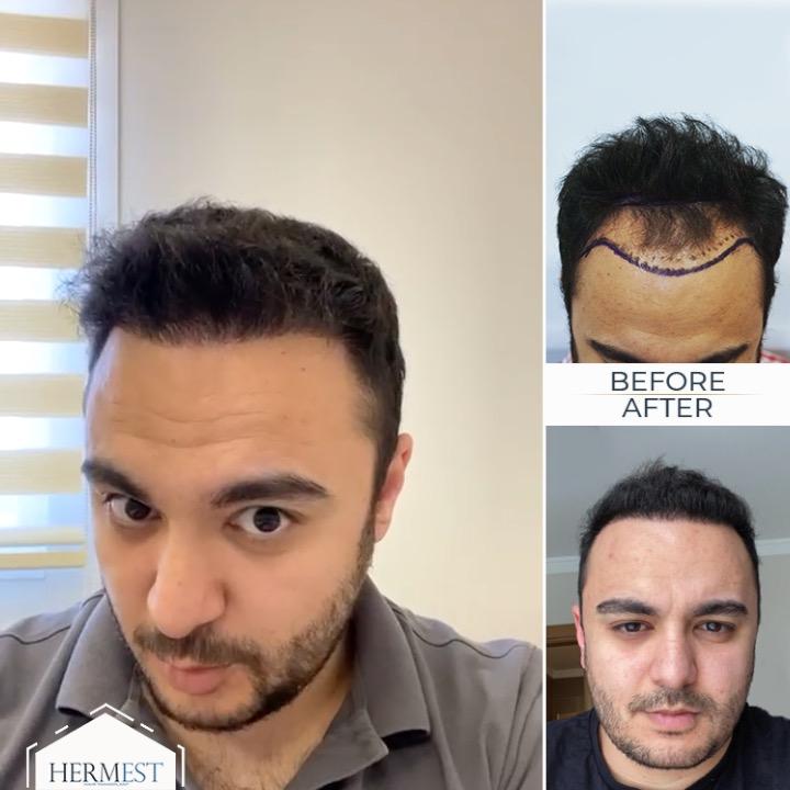 Wie lange hält eine Haartransplantation wirklich? 2 Vorher-Nachher-Vergleich