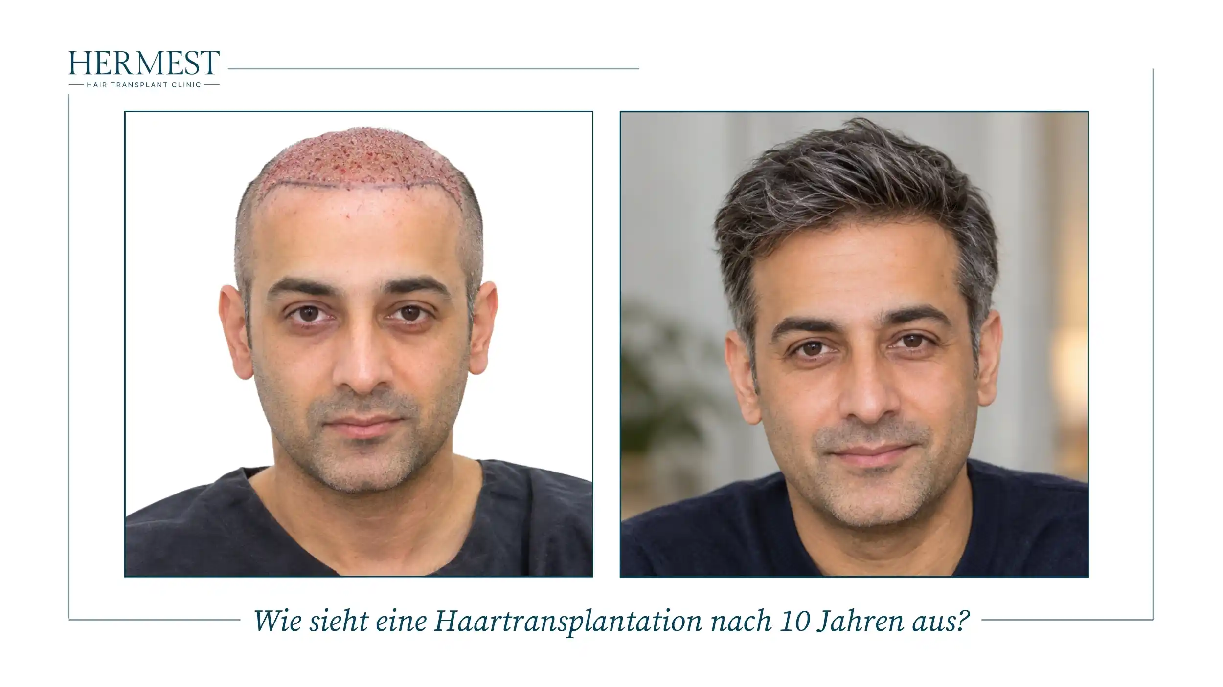 Wie sieht eine Haartransplantation nach 10 Jahren aus