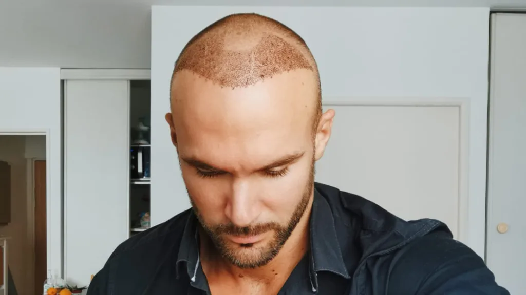 hair transplant timeline