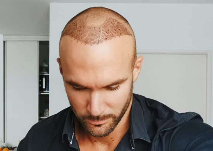 Hair Transplant Timeline: What to Expect from Day 1 to 12 Months 14 hair transplant timeline