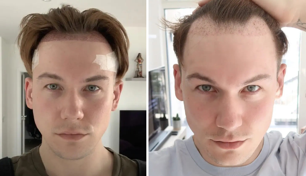 Hair Transplant Timeline: What to Expect from Day 1 to 12 Months 2 hair transplant timeline months