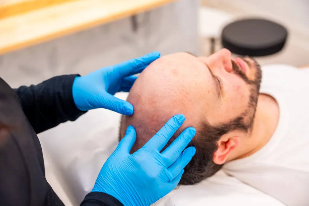 Haartransplantation bei Halbglatze