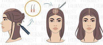 Langhaartransplantation bei Frauen