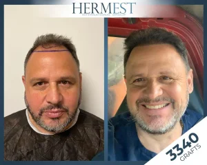Vorher-Nachher-Bild einer Haartransplantation bei Hermest