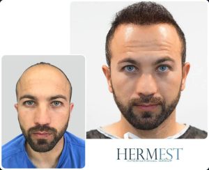 Haartransplantation Schwellung – Ist das gefährlich? 2 Vorher Nachher Vergleich einer Haartransplantation