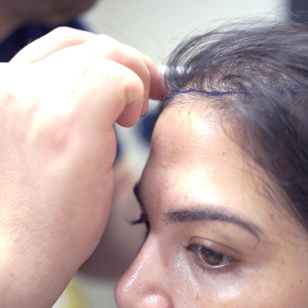 best hair transplant woman
