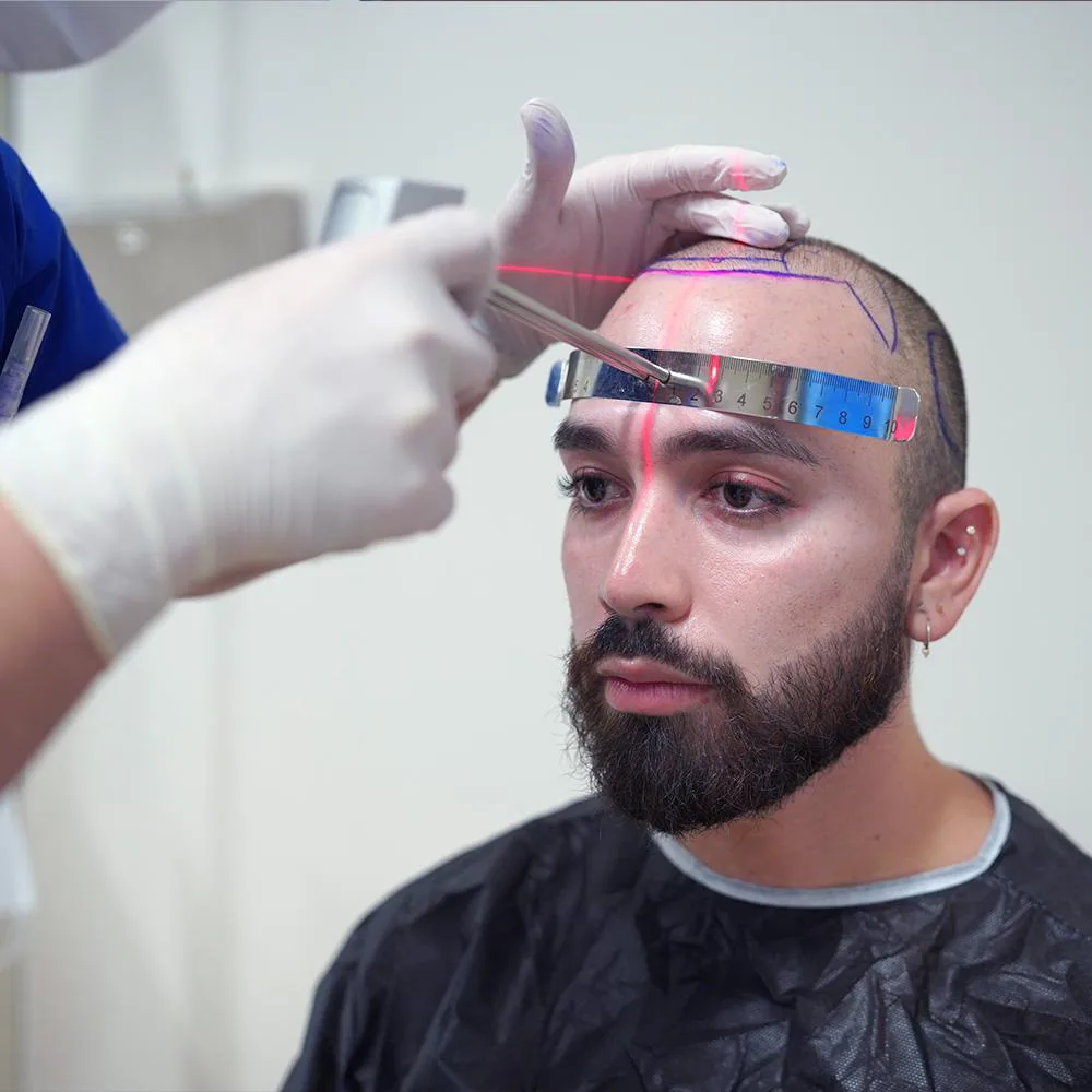 Doctor measuring a patient's frontal hairline with a ruler during a hair loss assessment