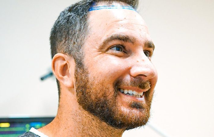 Long Hair Fue 46 dhi hair transplant hermest