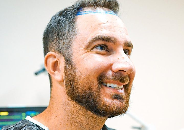 Things to Avoid After Hair Transplant: What Not to Do for Better Results 14 dhi hair transplant hermest