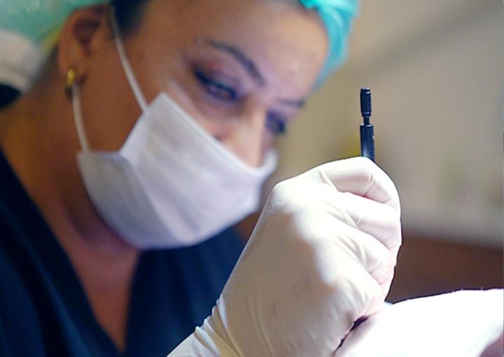 FUE Hair Transplant 3 fue hair transplant surgeon pen closeup