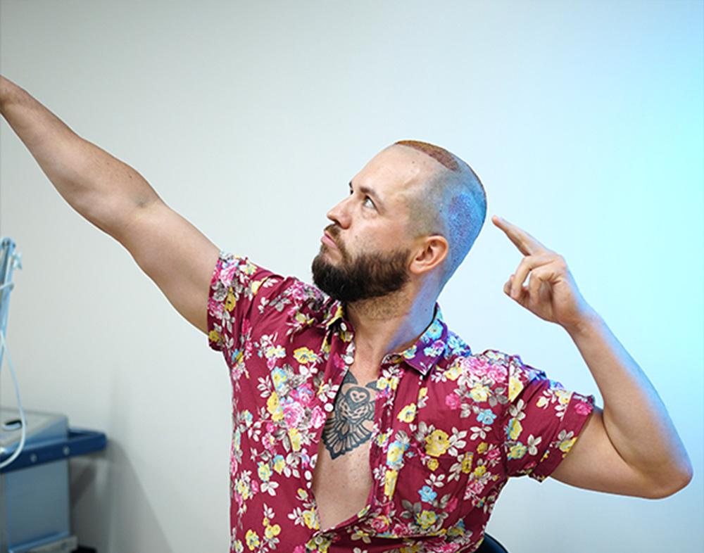 fue hair transplant turkey patient after surgery
