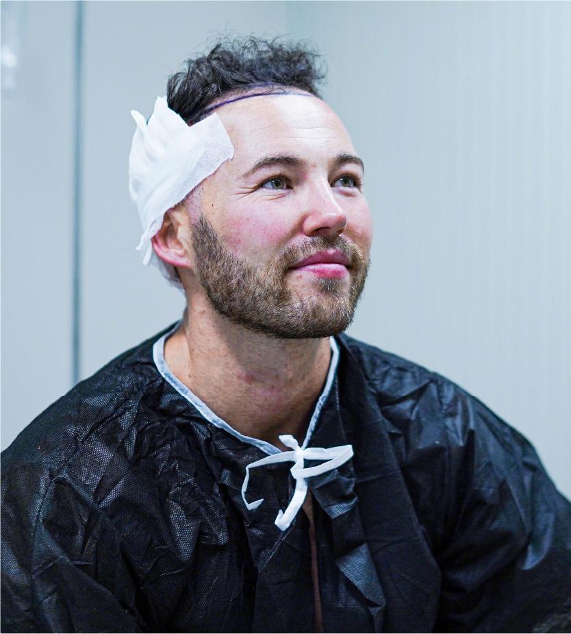 fue transplant patient post operation turkey