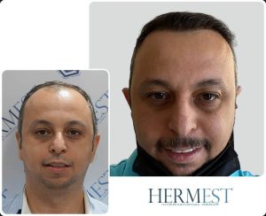 hair transplant all reviews