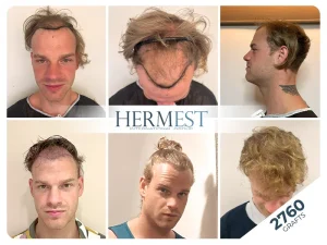 hair transplant turkey before after 2760 grafts