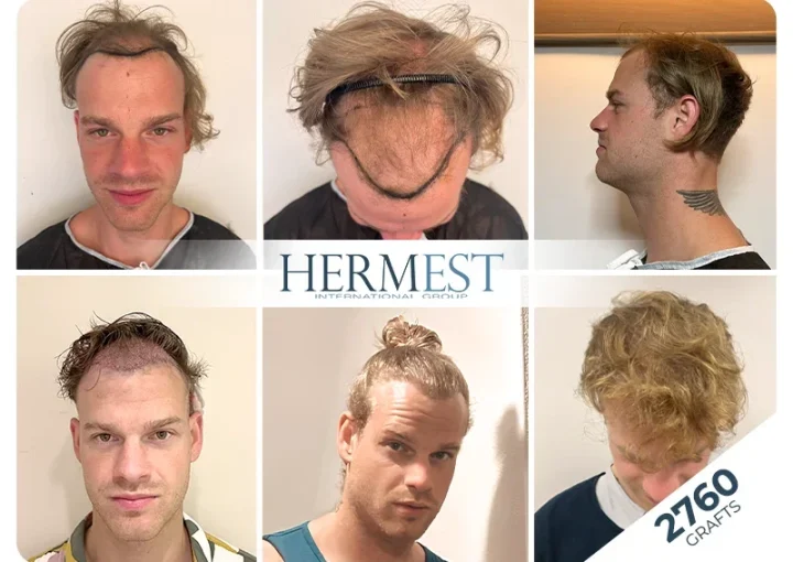 hair transplant turkey before after 2760 grafts