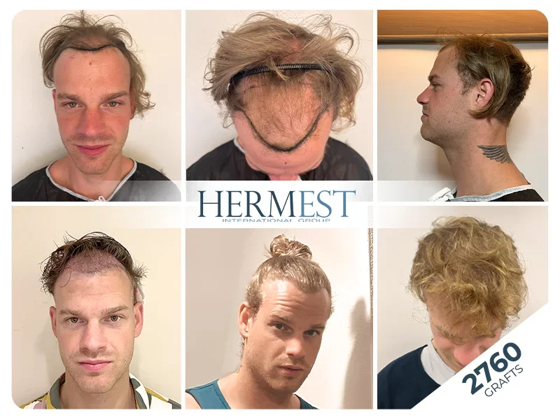 hair transplant turkey before after 2760 grafts