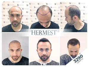 hair transplant turkey before after 3290 grafts