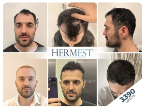 hair transplant turkey before after 3390 grafts
