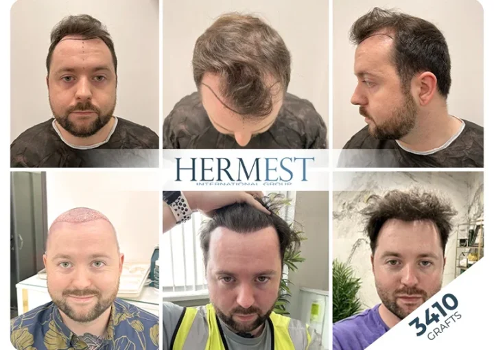 How Many Hair Grafts Do I Need? Accurate Graft Planning Guide (2026) 8 hair transplant turkey before after 3410 grafts