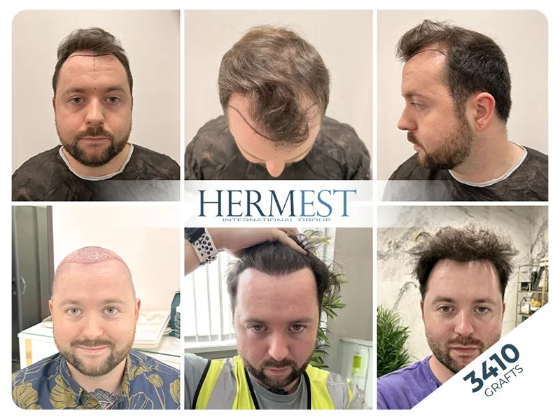 hair transplant turkey before after 3410 grafts