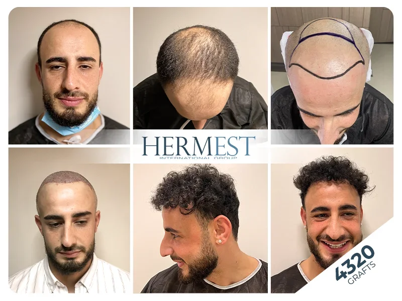 hair transplant turkey before after 4320 grafts