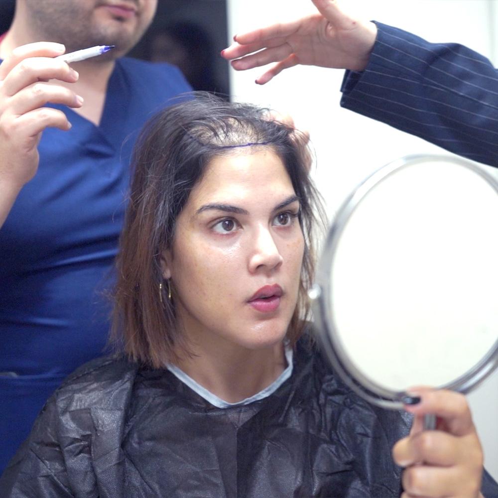 hair transplant woman in turkey