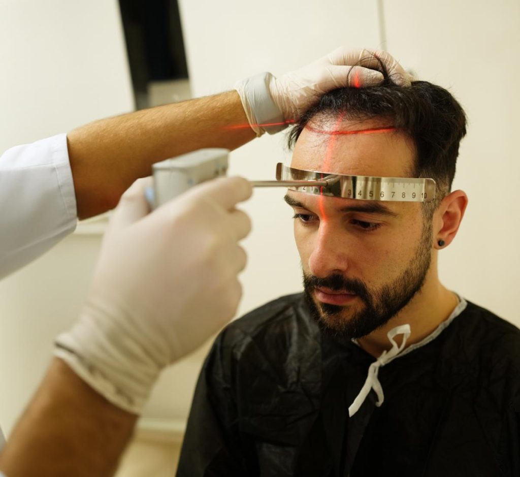 laser guided dhi hairline planning