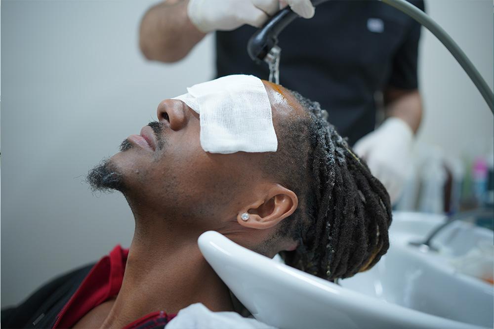long hair fue patient showing hairline