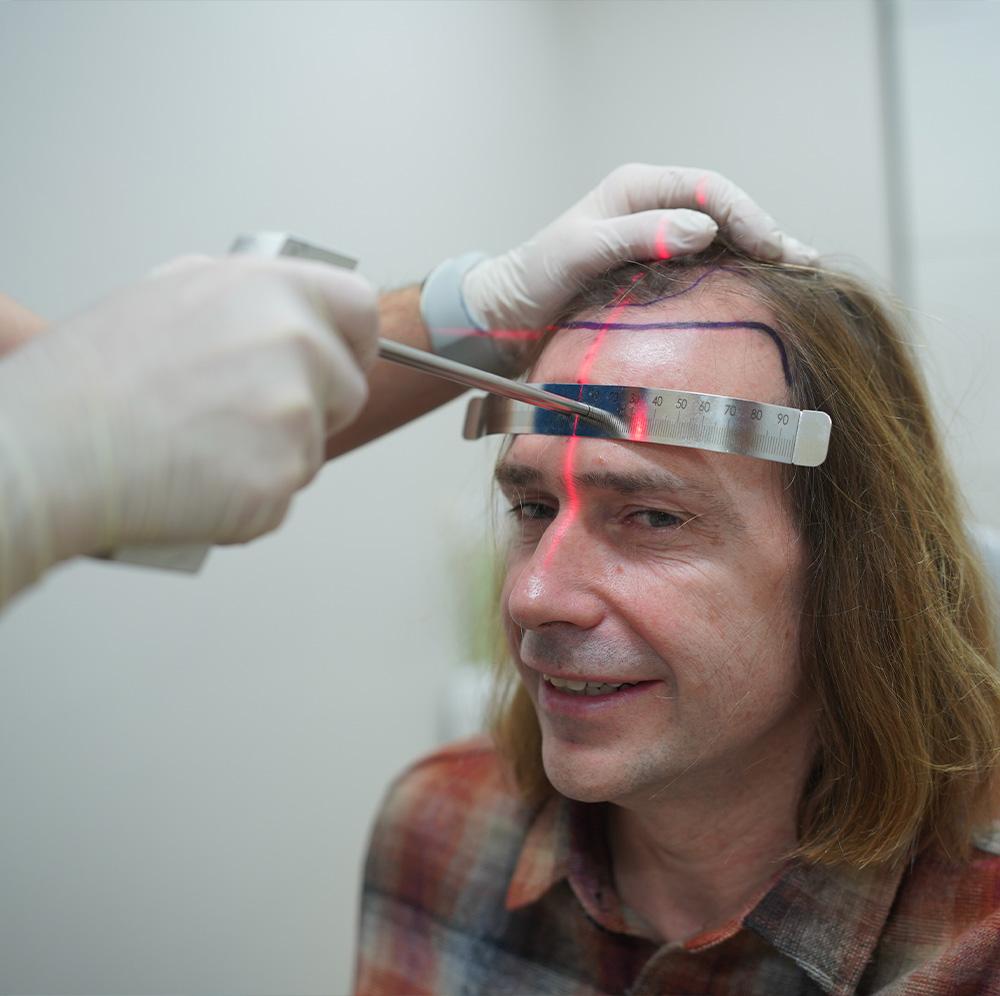 long hair fue surgery