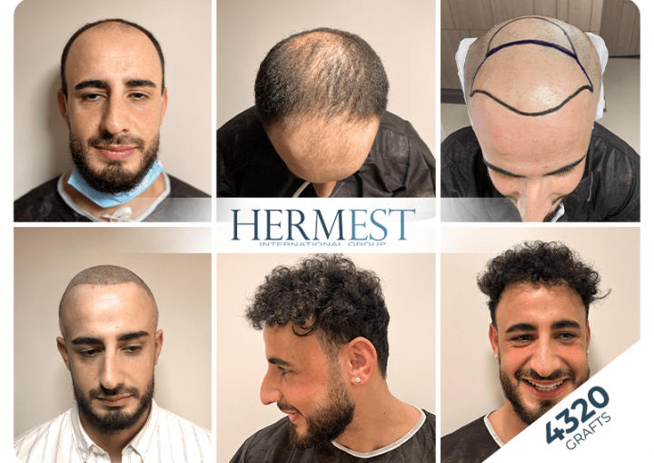 4000 Grafts Hair Transplant: Coverage, Cost & Recovery 8 sac ekimi oncesi sonrasi 4320 grafts