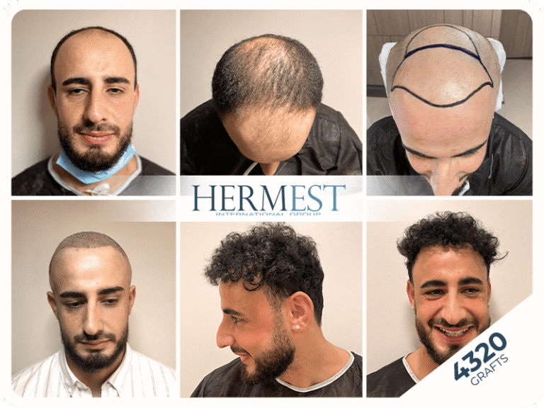 sac ekimi oncesi sonrasi 4320 grafts