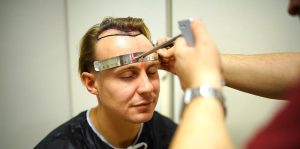 unshaven hair transplant hairline design