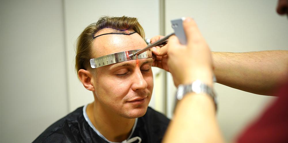unshaven hair transplant hairline design