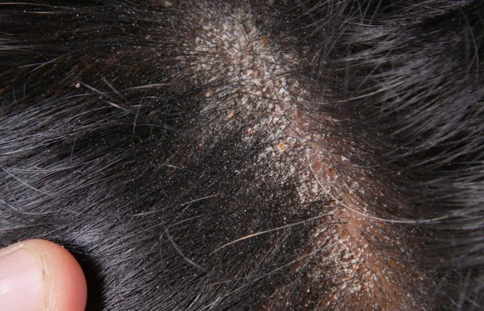 Haartransplantation Narbe – Können Narben überdeckt werden? 11 Haartransplantation Narben