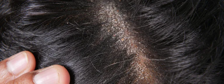 Haartransplantation Narben