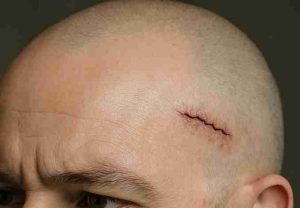 Haartransplantation Narbe – Können Narben überdeckt werden? 2 Haartransplantation bei Narbe