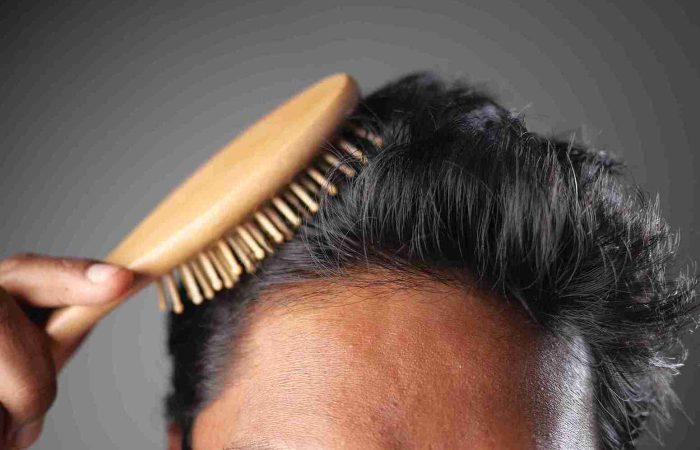 Haartransplantation ohne Eigenhaar – Möglichkeiten und Risiken 12 Haartransplantation ohne Eigenhaar